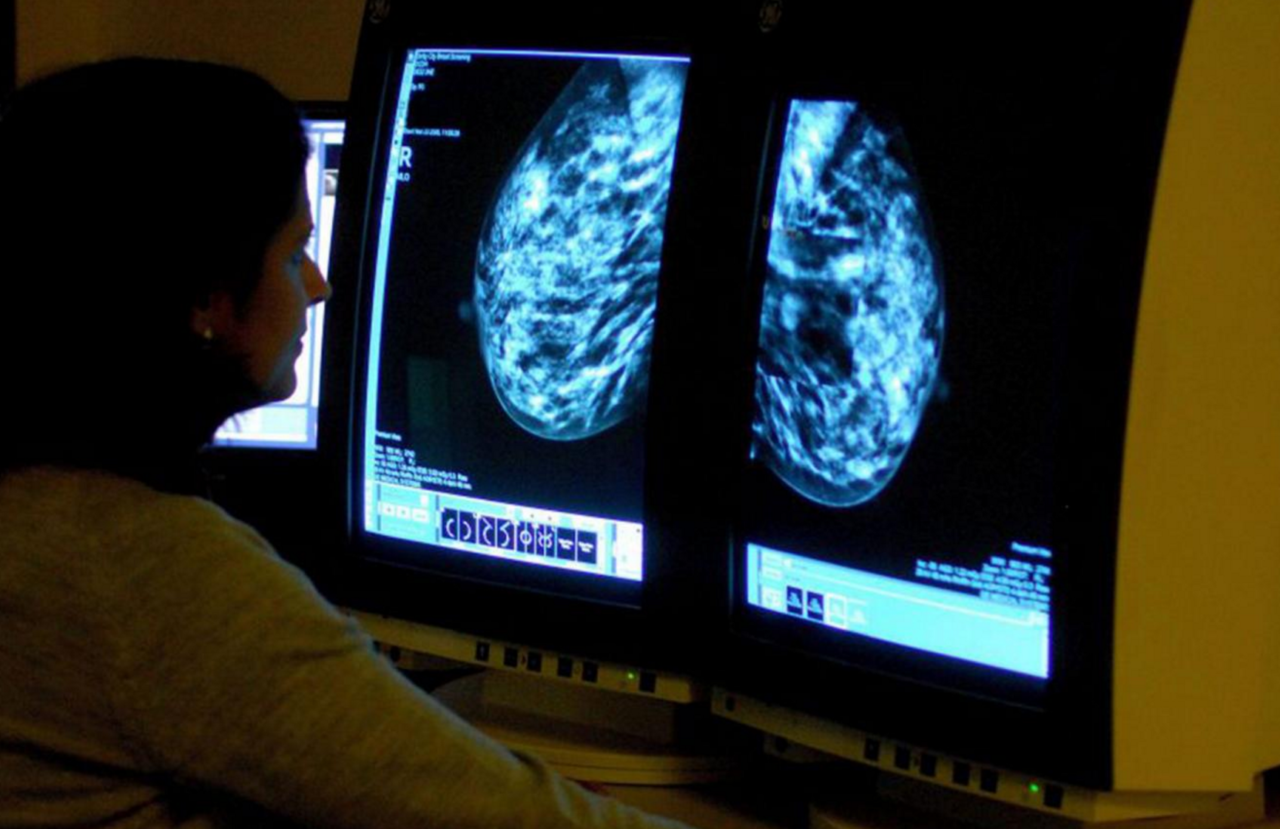 You are currently viewing Researchers say low-fat diet contains breast cancer