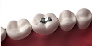 Read more about the article More than eight dental fillings may up mercury levels in the blood!