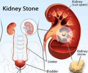 Read more about the article Prevent Kidney Stones via healthful diet!