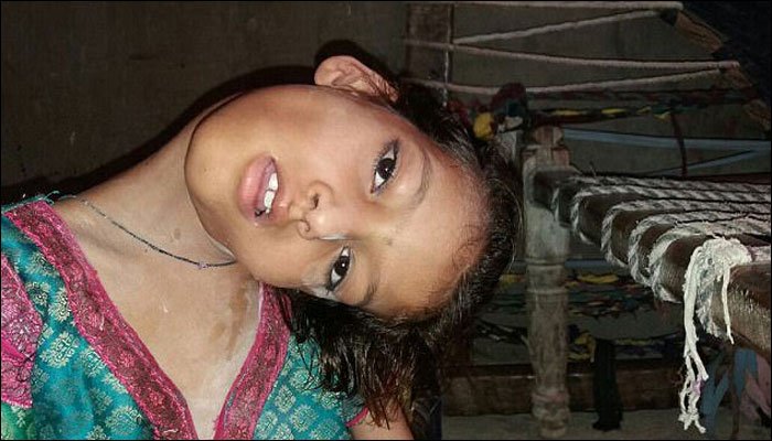 Read more about the article A minor in Mithi is living with hanging head, a rarest disorder!