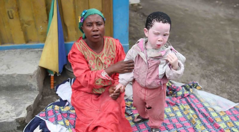 Read more about the article Theme of 2021 Int’l Albinism Awareness day is Strength Beyond All Odds